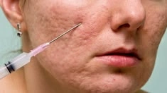 Types of acne scars - ice pick, boxcar and rolling scars explained